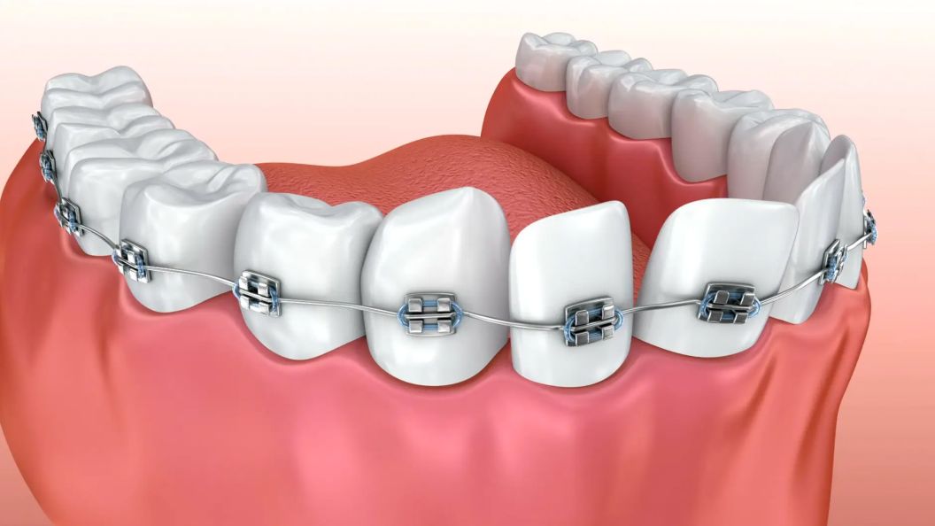How do fixed braces work?