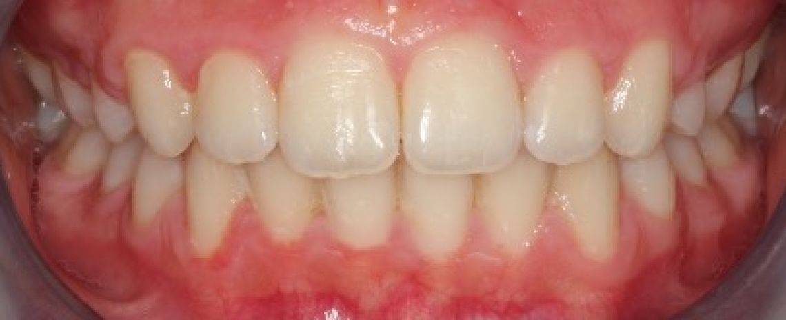  Invisalign teeth alignment After