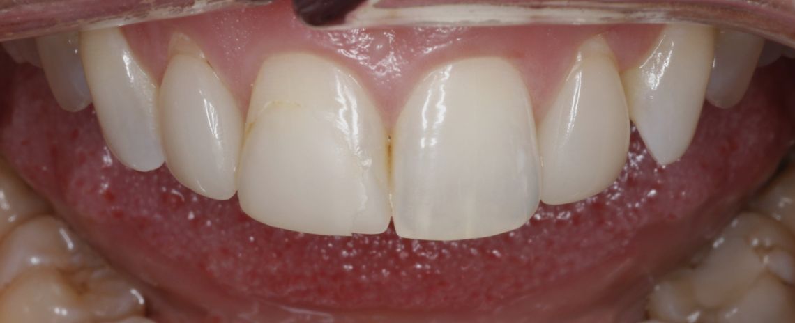 Single Central Composite Composite Bonding Before