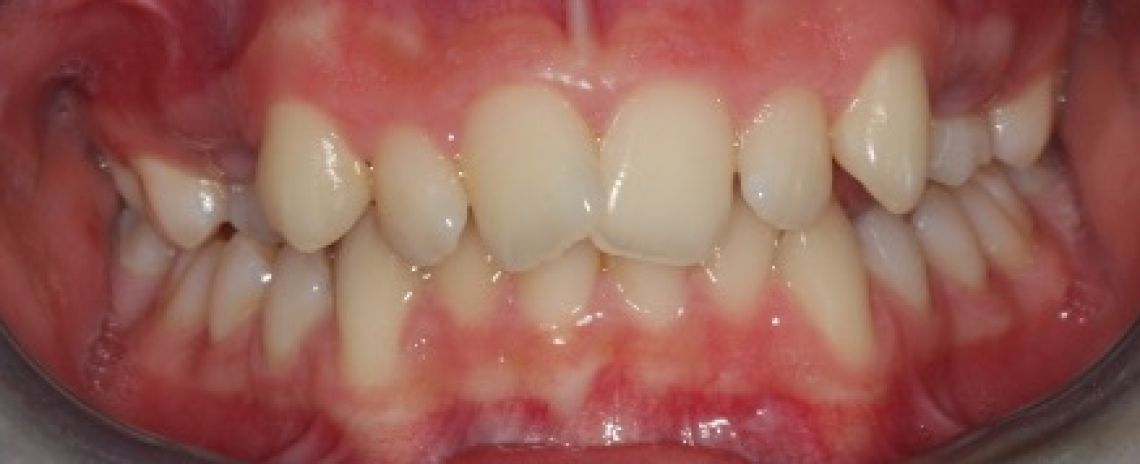  Invisalign teeth alignment Before