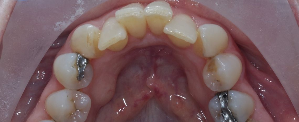  Invisalign & Replacing Amalgam Fillings Before