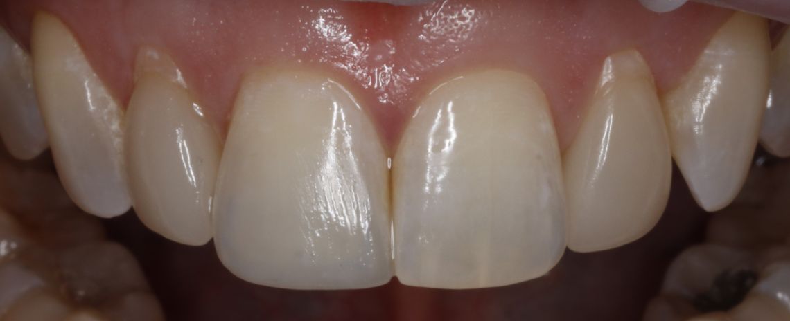 Single Central Composite Composite Bonding After