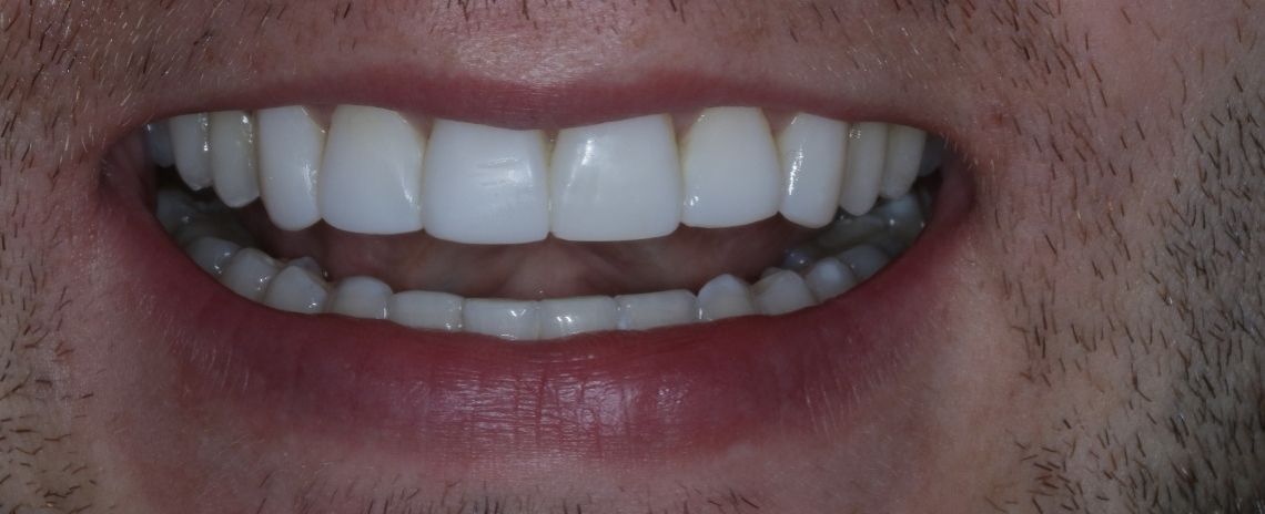  Composite Veneers After