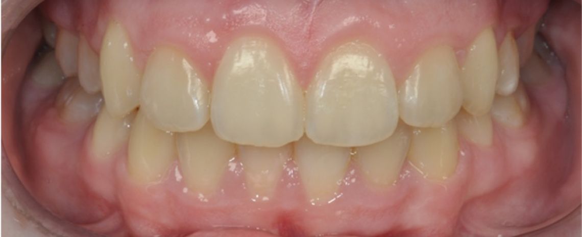 Case 2 Orthodontics Crowded teeth  Narrow upper jaw  Expansion appliance  Metal fixed braces  18 months  After