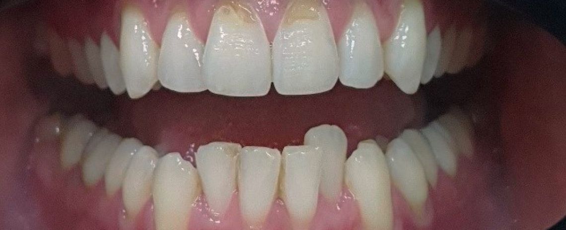 Invisalign® Invisalign teeth alignment Before