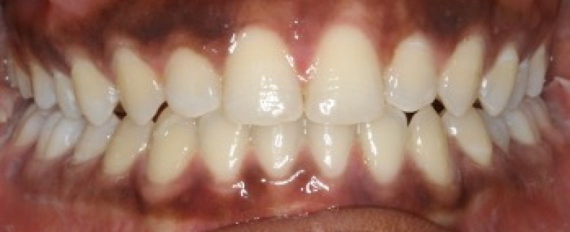 Case 4 Orthodontics Spaced teeth  Invisalign aligners treatment  10 months  After