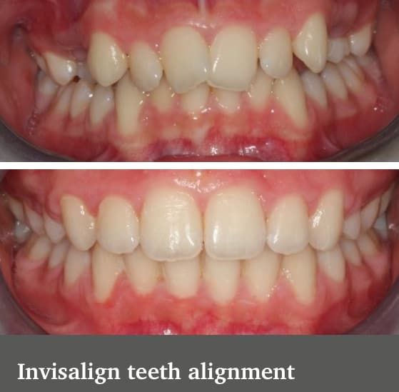 Invisalign Teeth alignment