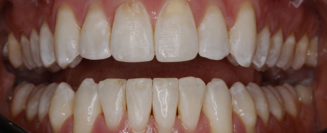 Invisalign® Invisalign teeth alignment After