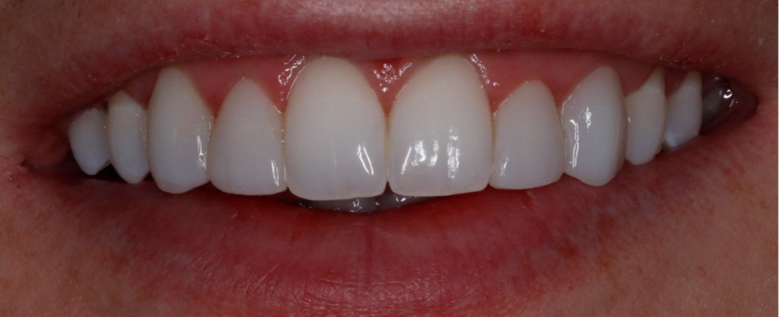 Composite bonding Dr Rory Composite bonding After