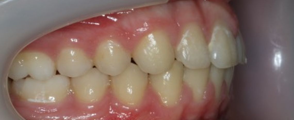 Case 5 Orthodontics Improper bite with 14 mm overlap of the front teeth (Overjet)  Functional braces 10 months followed by metal braces 12 months  No extractions done  After
