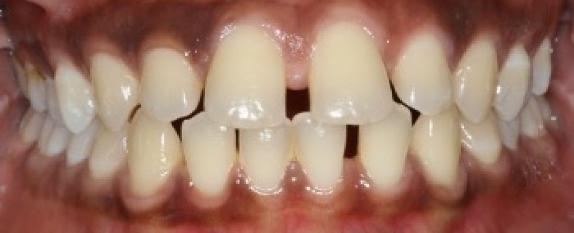 Case 4 Orthodontics Spaced teeth  Invisalign aligners treatment  10 months  Before