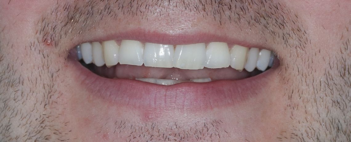  Composite Veneers Before