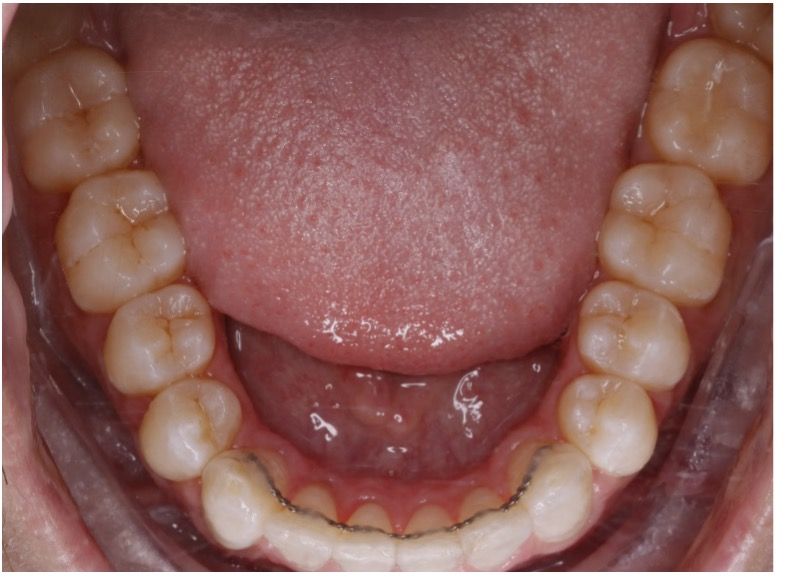 Invisalign before and after