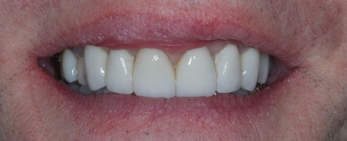  Veneers After