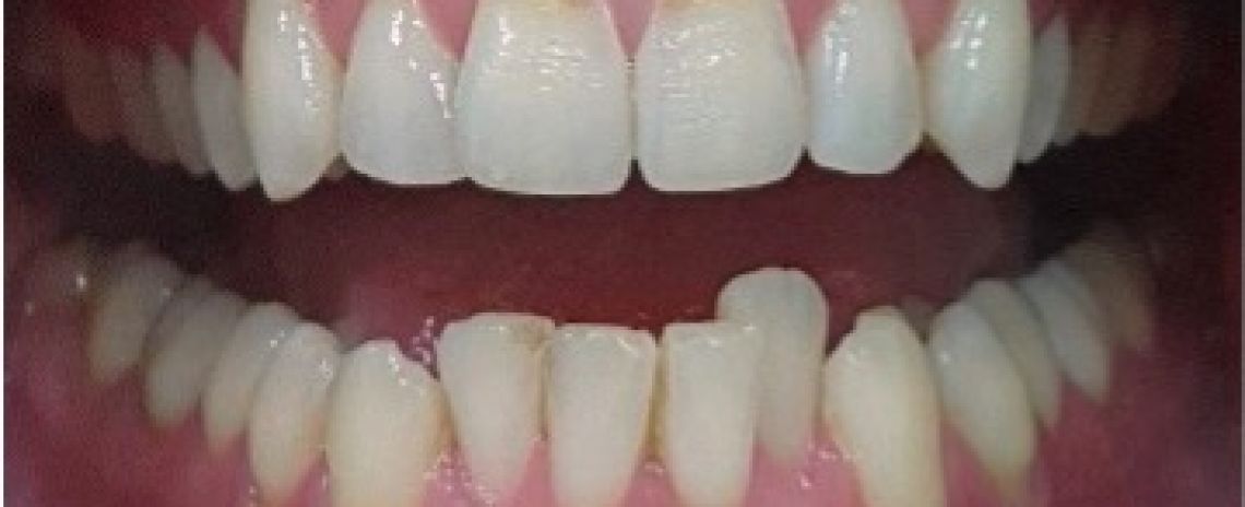 Invisalign treatment Dr Rory Invisalign Before