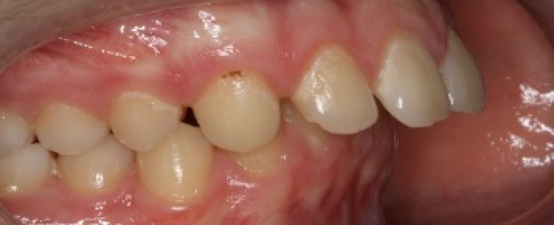Case 5 Orthodontics Improper bite with 14 mm overlap of the front teeth (Overjet)  Functional braces 10 months followed by metal braces 12 months  No extractions done  Before