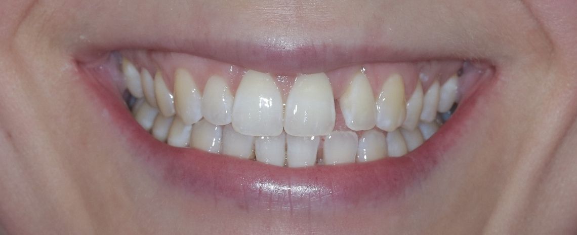  Invisalign & Composite Bonding Before
