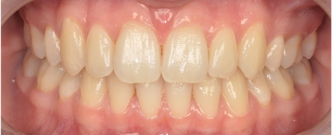 Crowded teeth Improper bite White ceramic braces 15 months Treatment After