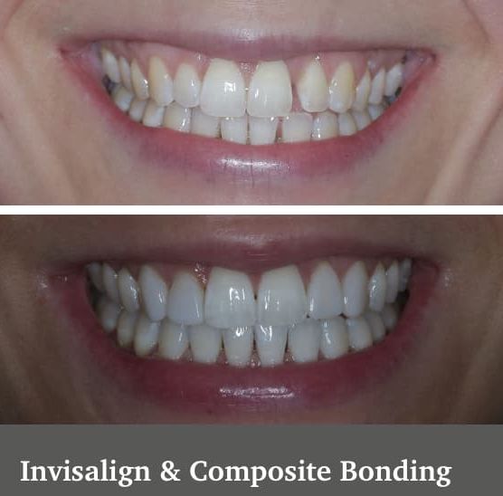 Invisalign and composite bonding
