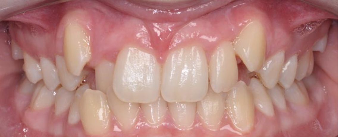Crowded teeth Improper bite White ceramic braces 15 months Treatment Before