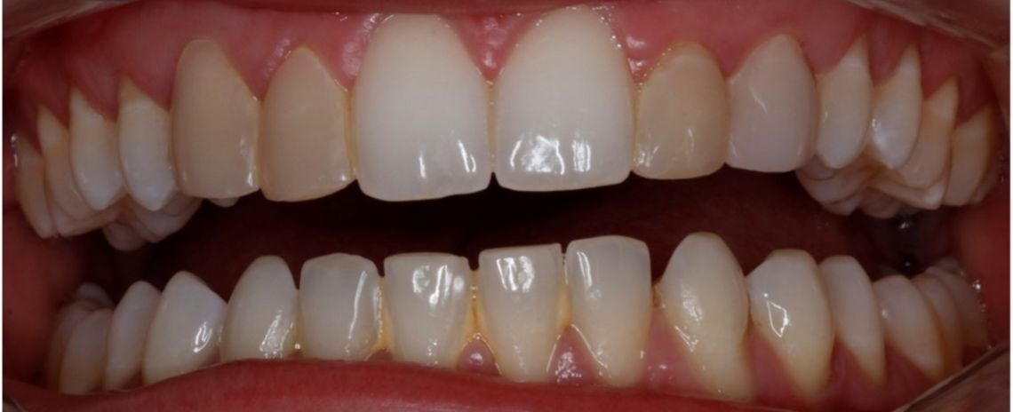 Composite bonding Dr Rory Composite bonding Before