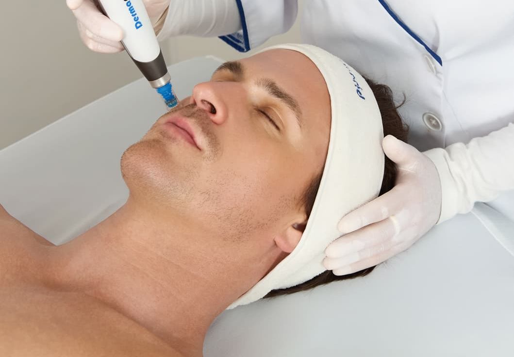 what is micro needling?