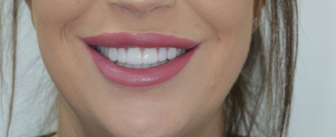  Veneers After