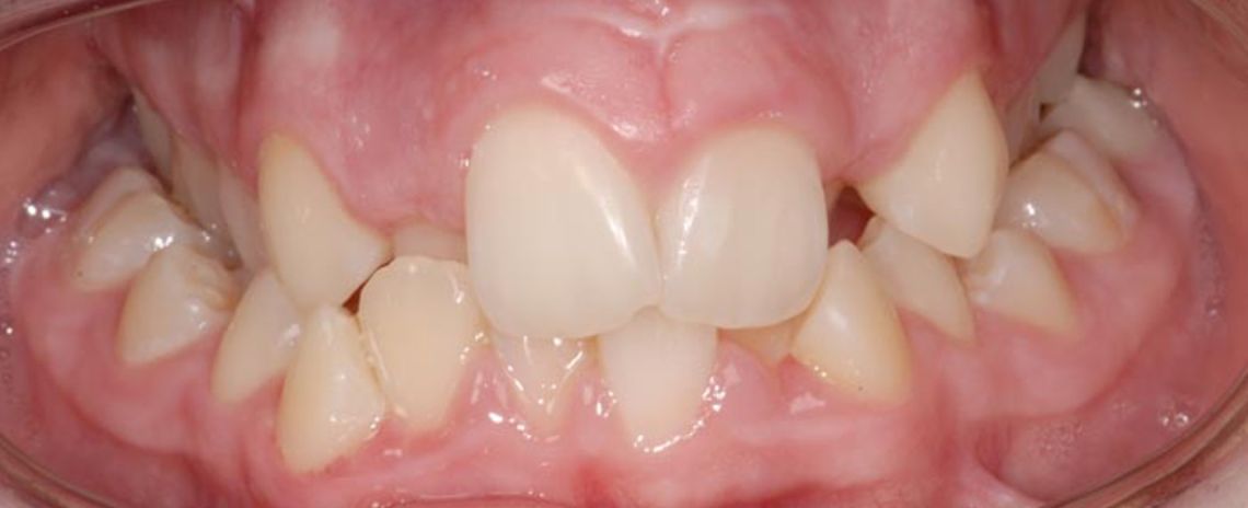 Case 2 Orthodontics Crowded teeth  Narrow upper jaw  Expansion appliance  Metal fixed braces  18 months  Before