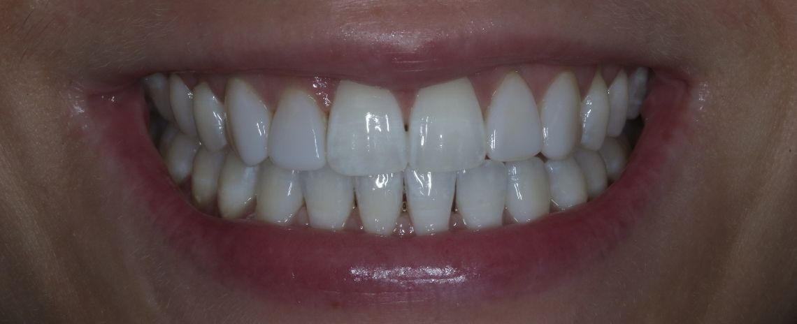  Invisalign & Composite Bonding After